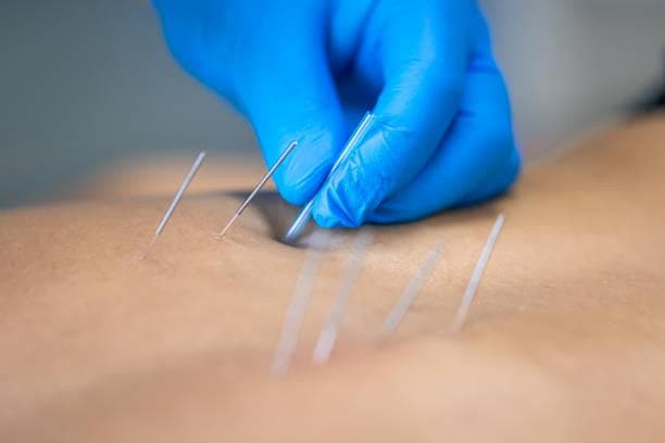 Dry Needling Technique