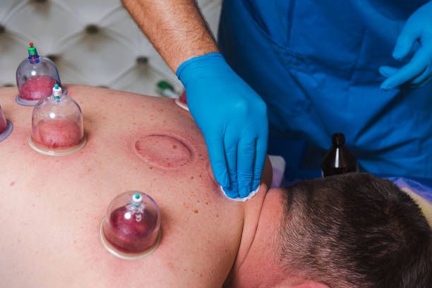 Cupping Therapy in Rishikesh